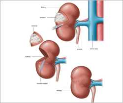 Nephrectomy