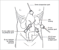 Laparoscopic Donor Nephrectomy